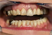 Full mouth reconstruction before treatment