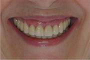 full mouth reconstruction smile after treatment