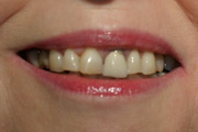 full mouth reconstruction smile before treatment