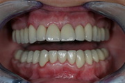 full mouth reconstruction after treatment