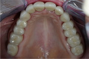 full mouth reconstruction after treatment