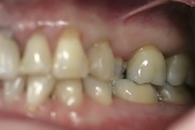 full mouth reconstruction before treatment