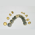 Prosthodontics - telescopic crown and bridge prosthesis
